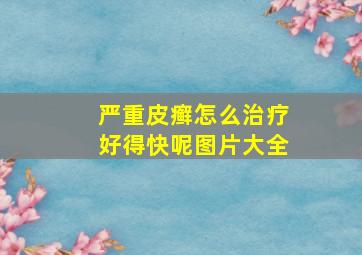 严重皮癣怎么治疗好得快呢图片大全