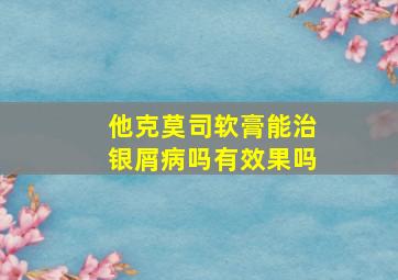 他克莫司软膏能治银屑病吗有效果吗