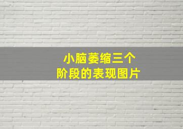 小脑萎缩三个阶段的表现图片