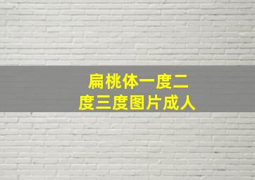 扁桃体一度二度三度图片成人