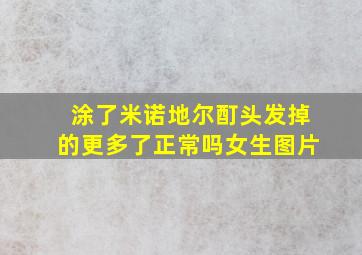 涂了米诺地尔酊头发掉的更多了正常吗女生图片