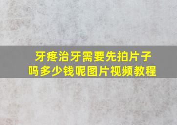 牙疼治牙需要先拍片子吗多少钱呢图片视频教程