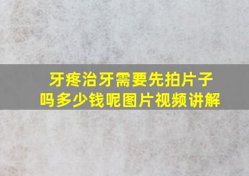 牙疼治牙需要先拍片子吗多少钱呢图片视频讲解