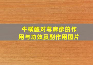 牛磺酸对荨麻疹的作用与功效及副作用图片