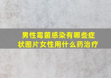 男性霉菌感染有哪些症状图片女性用什么药治疗