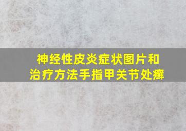 神经性皮炎症状图片和治疗方法手指甲关节处癣