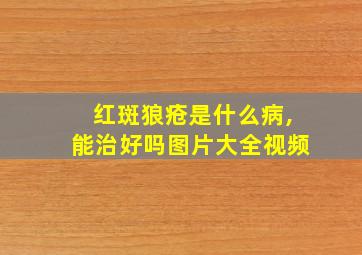 红斑狼疮是什么病,能治好吗图片大全视频