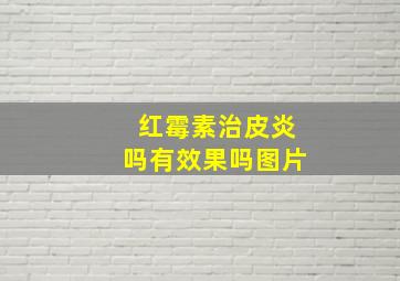 红霉素治皮炎吗有效果吗图片