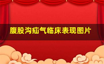 腹股沟疝气临床表现图片