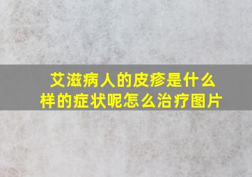 艾滋病人的皮疹是什么样的症状呢怎么治疗图片