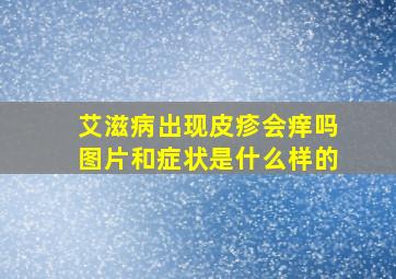 艾滋病出现皮疹会痒吗图片和症状是什么样的