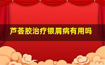 芦荟胶治疗银屑病有用吗