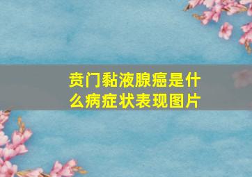 贲门黏液腺癌是什么病症状表现图片