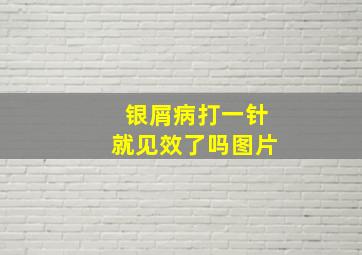 银屑病打一针就见效了吗图片