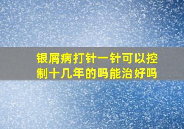 银屑病打针一针可以控制十几年的吗能治好吗