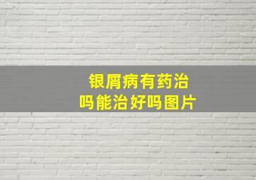 银屑病有药治吗能治好吗图片