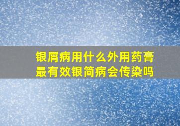 银屑病用什么外用药膏最有效银简病会传染吗