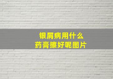 银屑病用什么药膏擦好呢图片