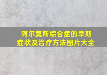 阿尔莫斯综合症的早期症状及治疗方法图片大全