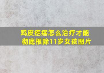 鸡皮疙瘩怎么治疗才能彻底根除11岁女孩图片