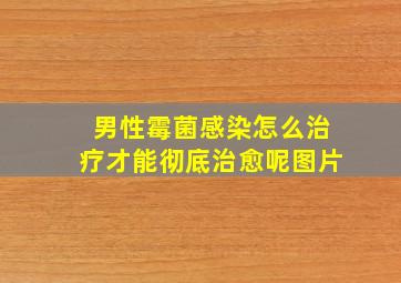 男性霉菌感染怎么治疗才能彻底治愈呢图片