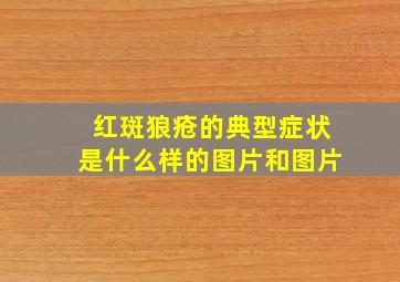 红斑狼疮的典型症状是什么样的图片和图片