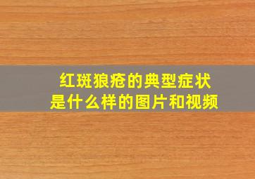 红斑狼疮的典型症状是什么样的图片和视频