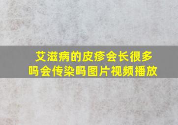 艾滋病的皮疹会长很多吗会传染吗图片视频播放